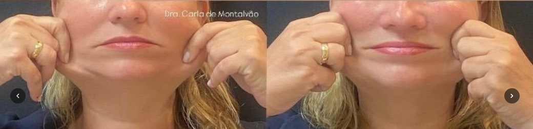 HiPro · Firmeza da pele antes e depois