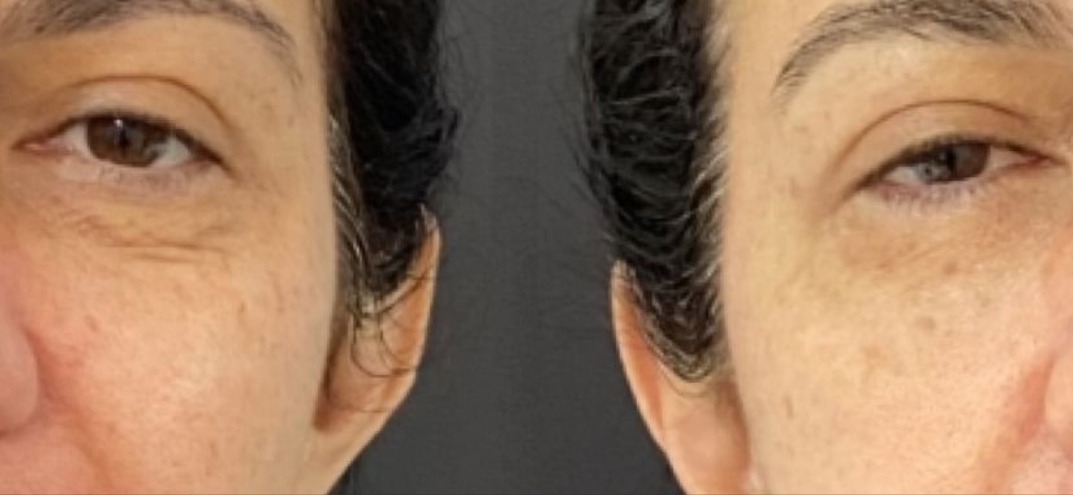 HiPro antes e depois