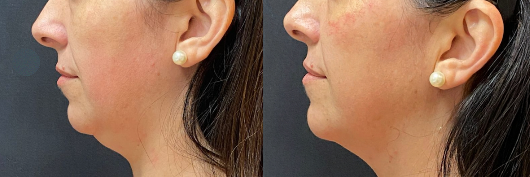 HiPro antes e depois
