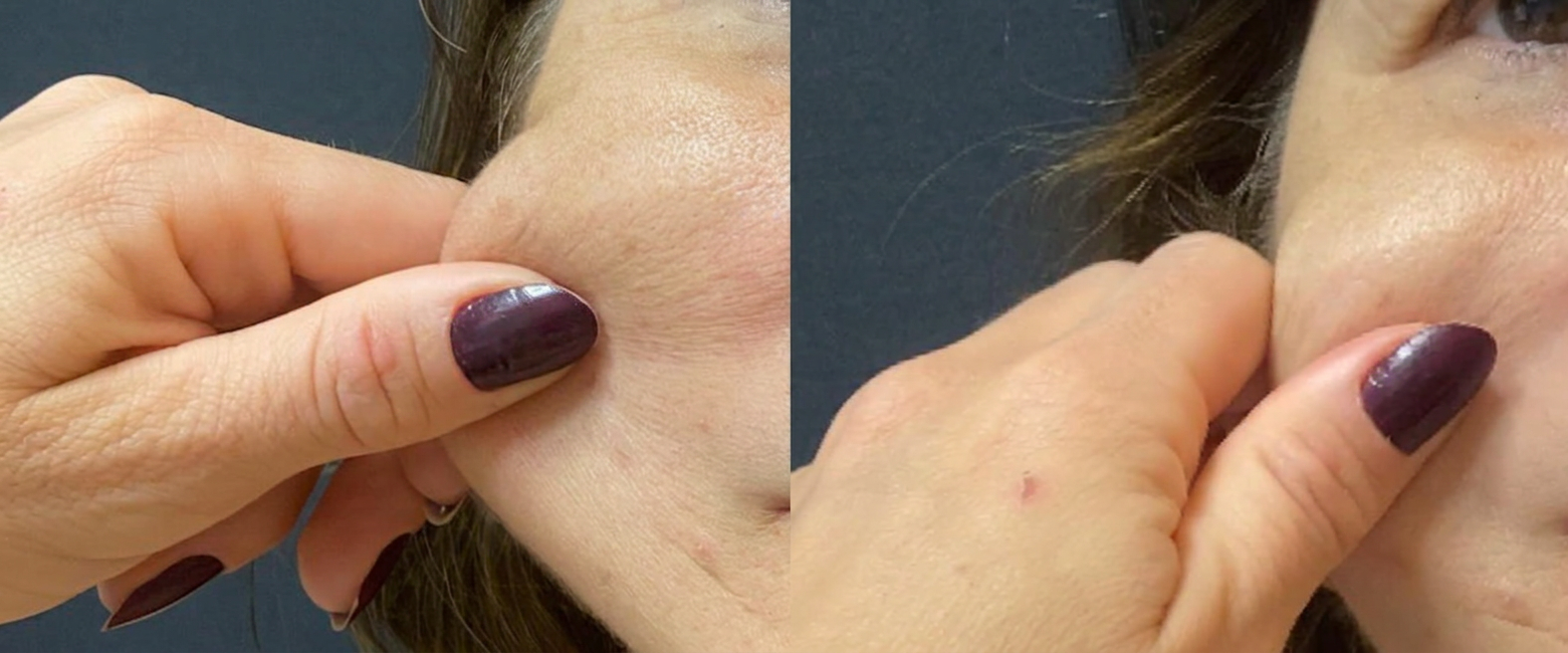 HiPro · Papada e contorno antes e depois